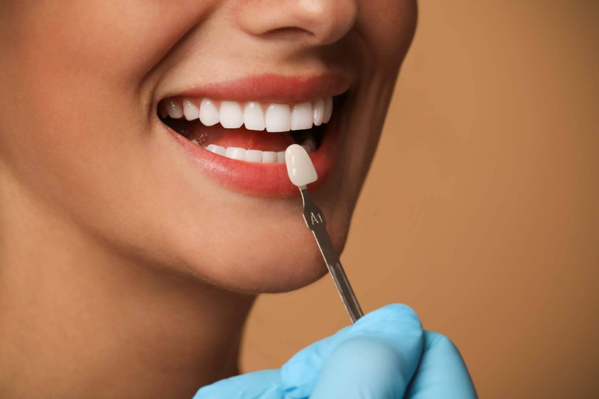Cobertura Dental presenta carillas dentales estéticas como solución personalizada